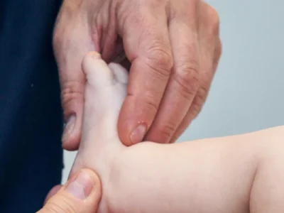 Il riflesso di Babinski è un riflesso primitivo che compare intorno all’11ª settimana di gestazione e si integra fisiologicamente entro il primo anno, in concomitanza con l’inizio della deambulazione.