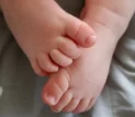 La sindattilia è una malformazione congenita (presente dalla nascita) che consiste nella fusione di due o più dita delle mani o dei piedi.